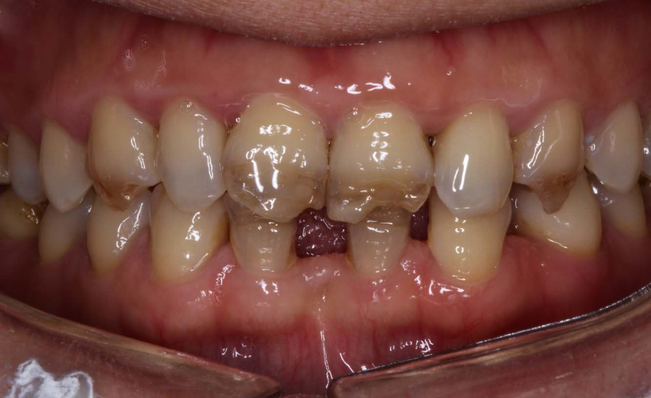 微创贴面修复解决牙齿的小小缺陷