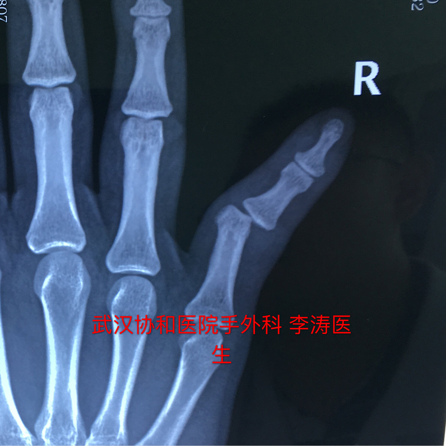 手指指间关节脱位的手术治疗 手指指间关节脱位的手术治疗