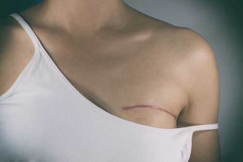 乳腺癌真人手术后图片图片