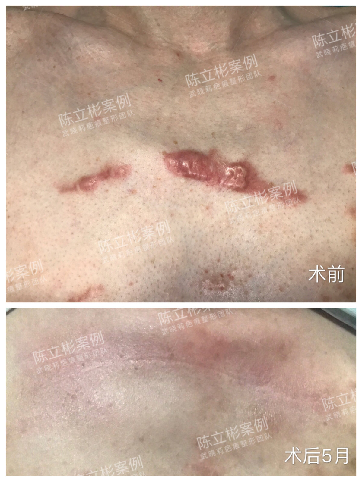 乳腺钙化手术后伤疤图图片