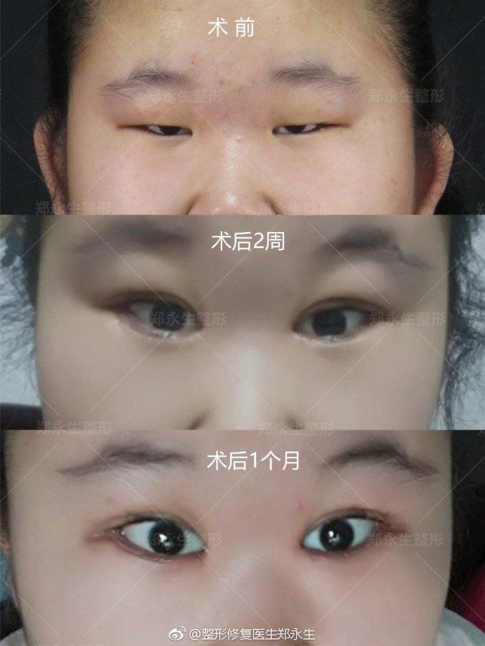 什么是先天性小眼症