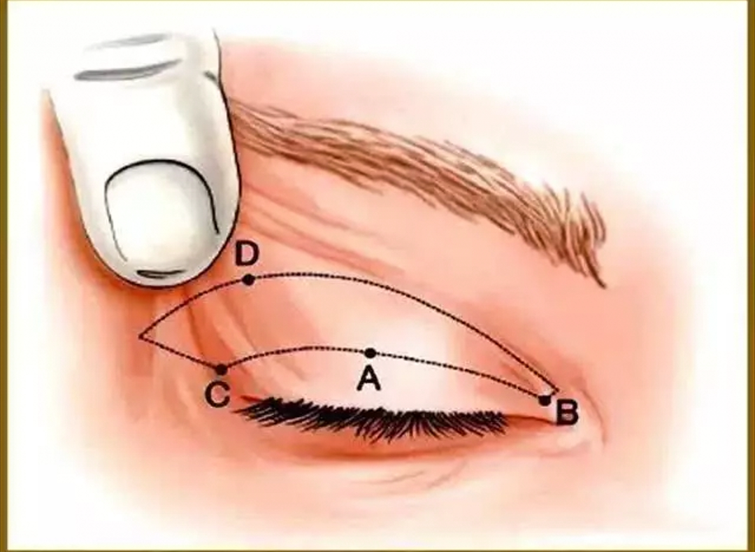 上瞼皮膚鬆弛下垂了怎麼辦?