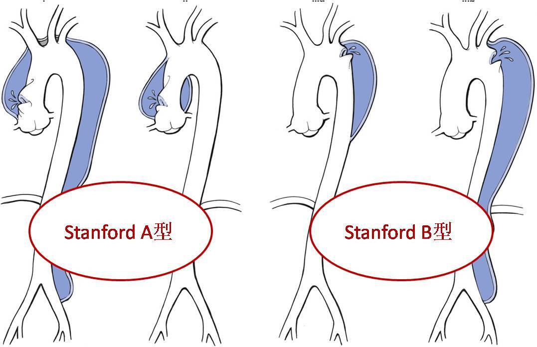 主动脉夹层stanford图片