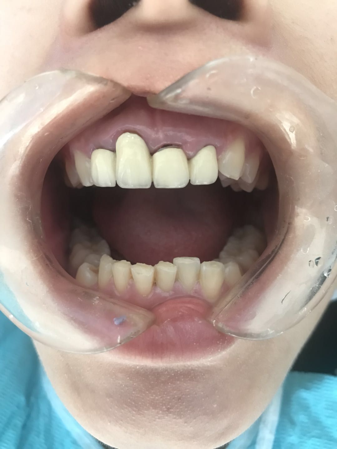 前牙美学修复病例 - 好大夫在线