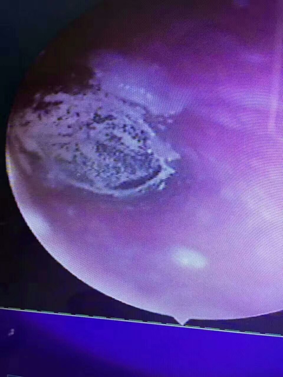 真菌性外耳道炎如何治疗 外耳道真菌病 病因 症状 治疗方法 预防 真菌性外耳道炎如何治疗 外耳道真菌病 病因 症状 治疗方法 预防