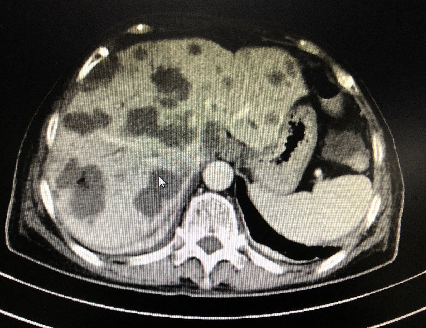 载药微球栓塞治疗肝脏多发转移瘤 - 好大夫在线