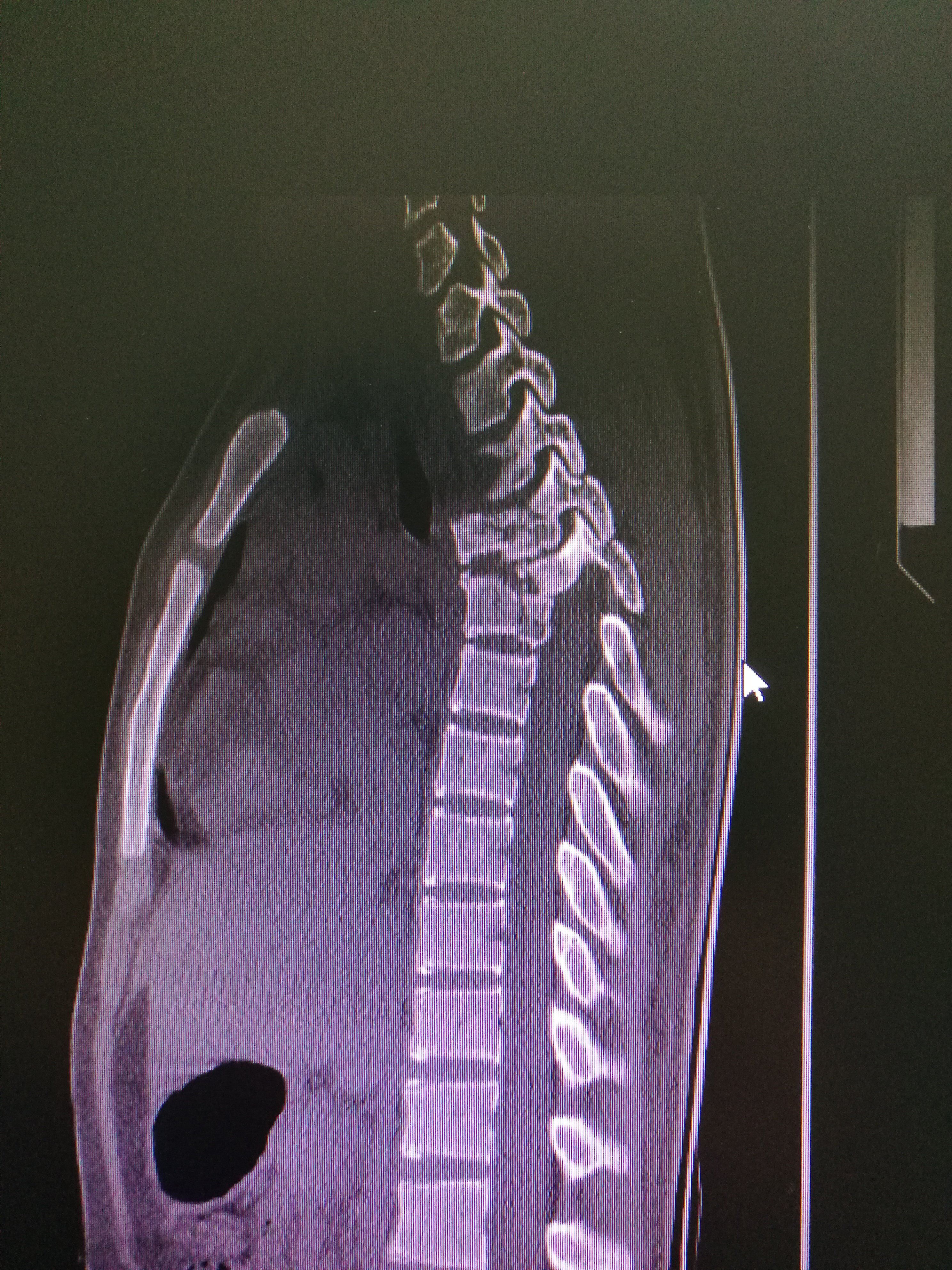 胸椎粉碎骨折严重移位下肢不全瘫手术治疗应用混合现实技术 - 好大夫