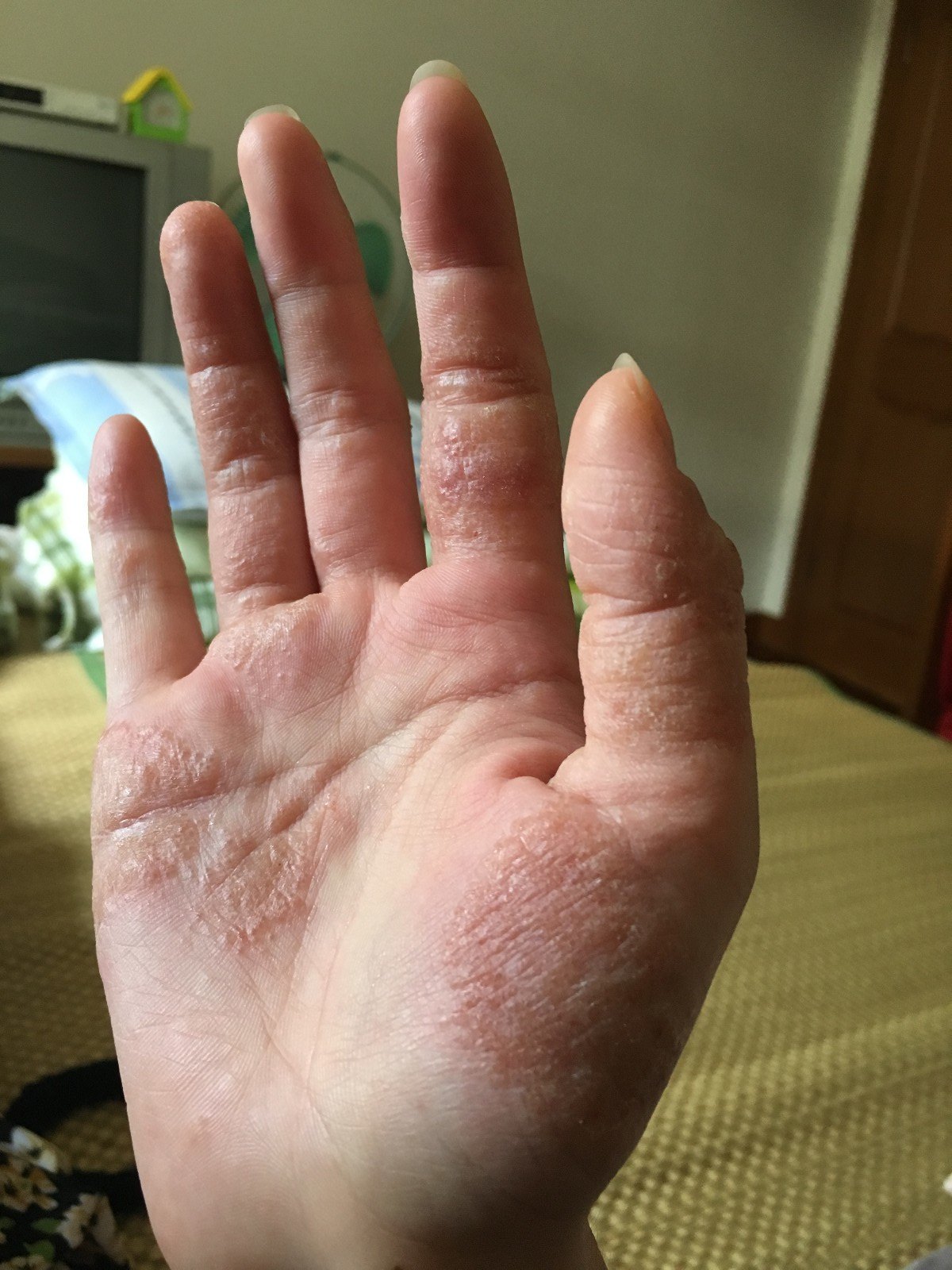 顽固性湿疹诊治案例图文分享