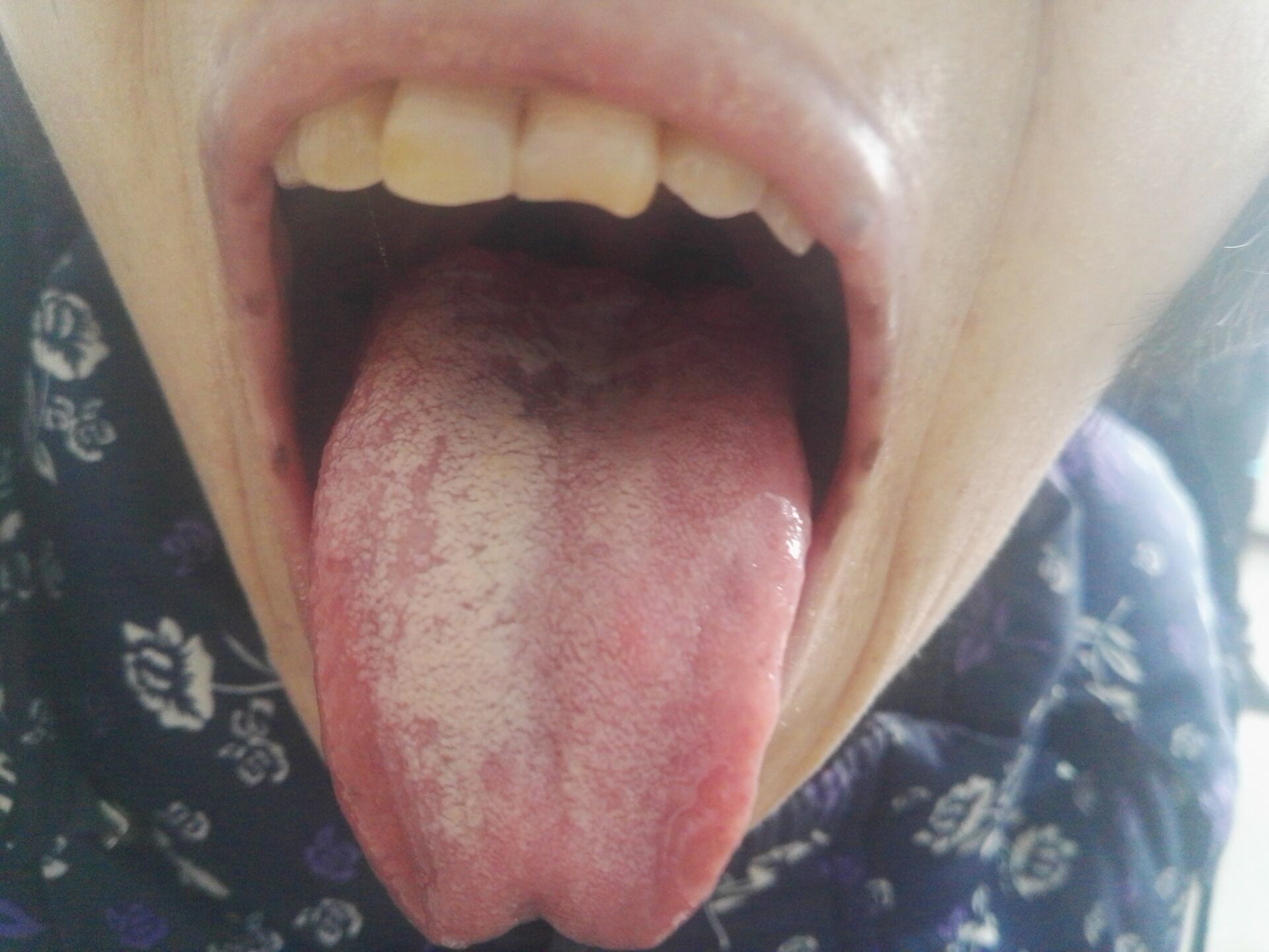胃癌患者舌苔图片图片