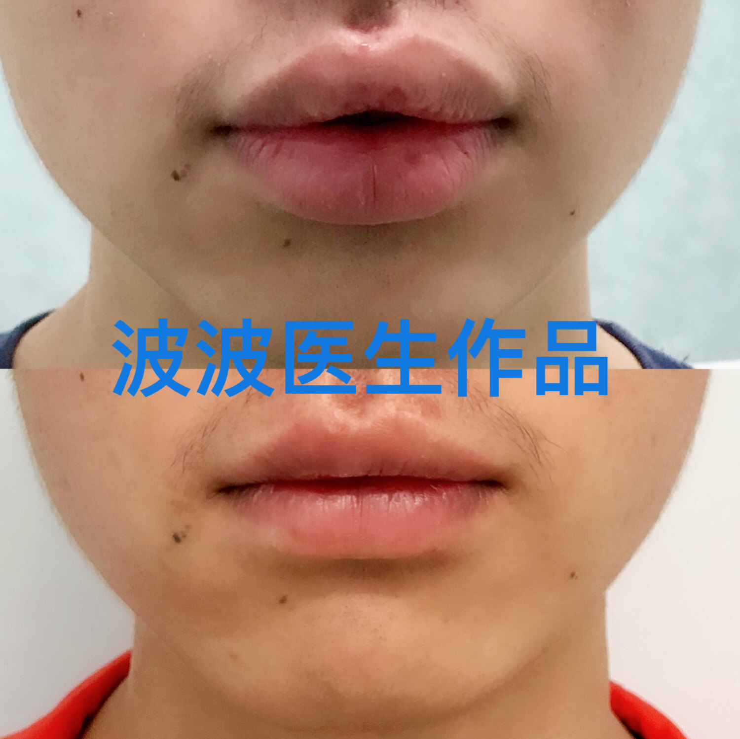 厚嘴唇 做改薄手术是否真的有用？