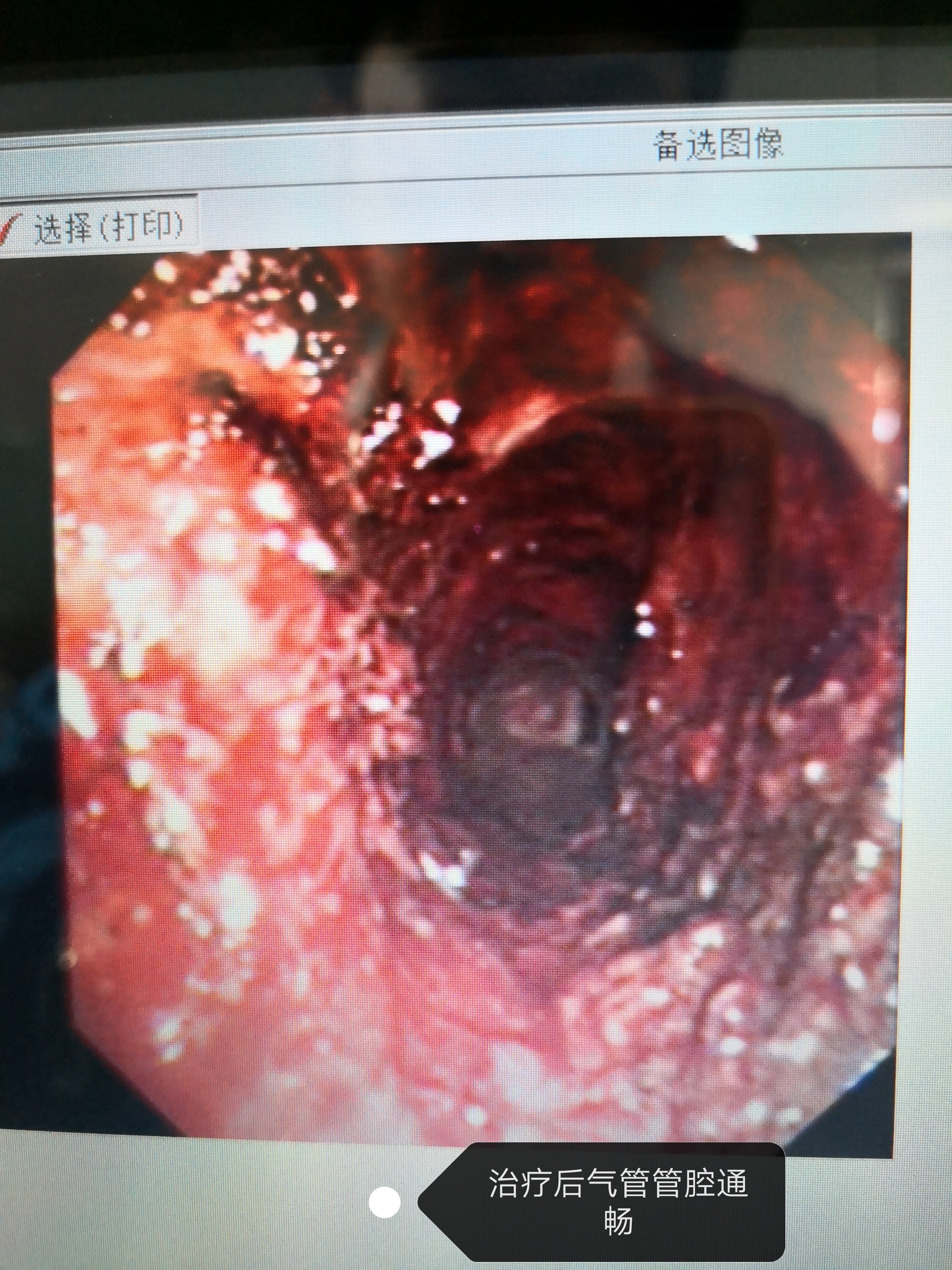 气管恶性肿瘤图片