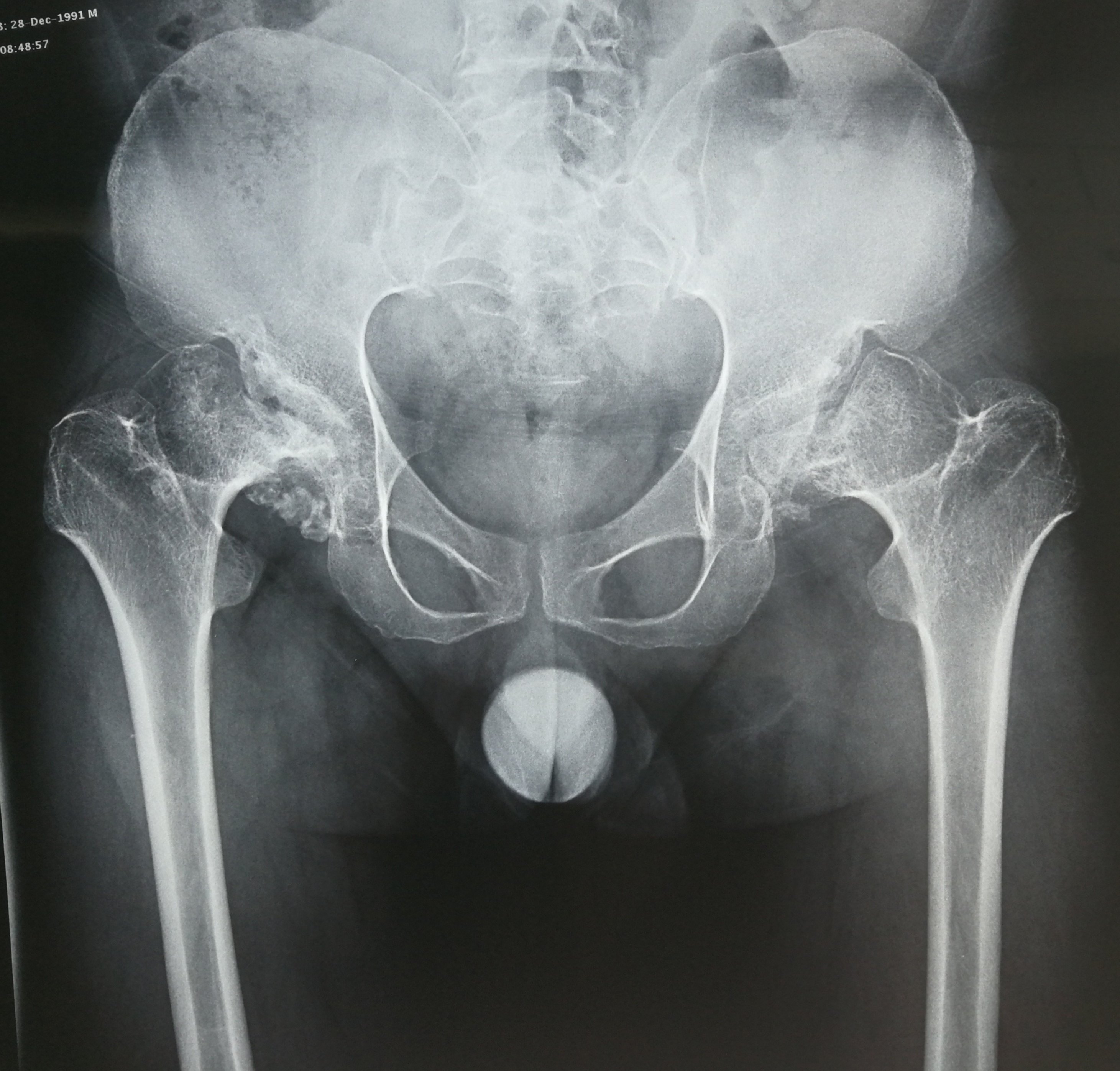 股骨头坏死,人工全髋关节置换术 - 好大夫在线