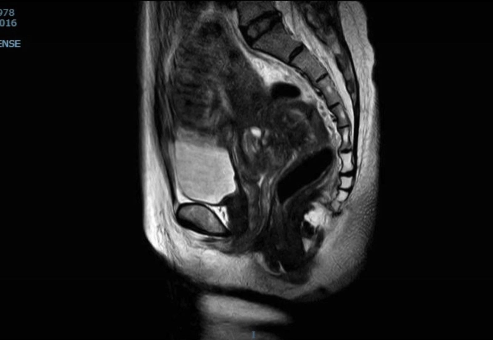 直肠深部子宫内膜异位症特殊案例汇报