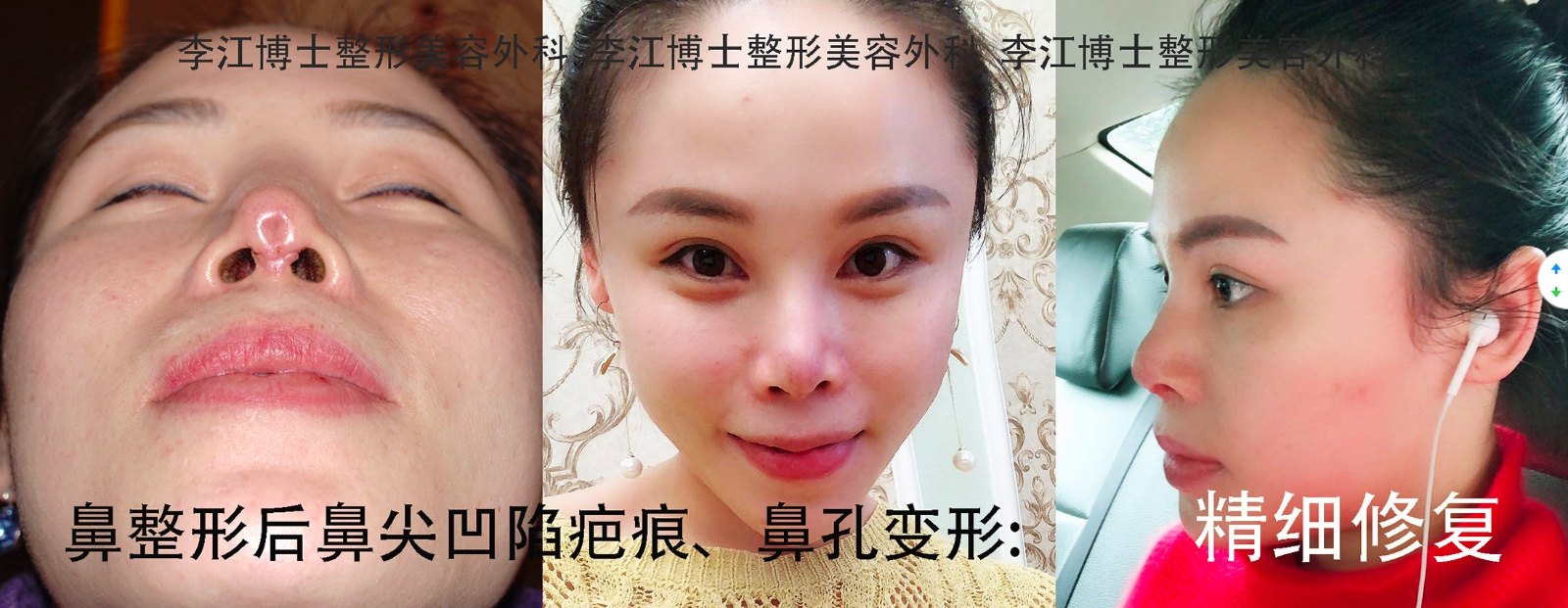 隆鼻修复 鼻综合修复 拯救被毁的鼻子 多彩图ok 鼻整形修复 隆鼻修复 鼻综合修复 拯救被毁的鼻子 多彩图ok 鼻整形修复