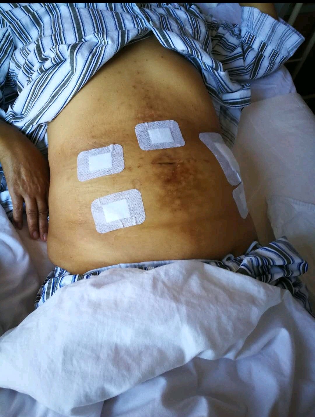 中西医治疗老年晚期卵巢癌至肿瘤影像消失并成功手术1例分享