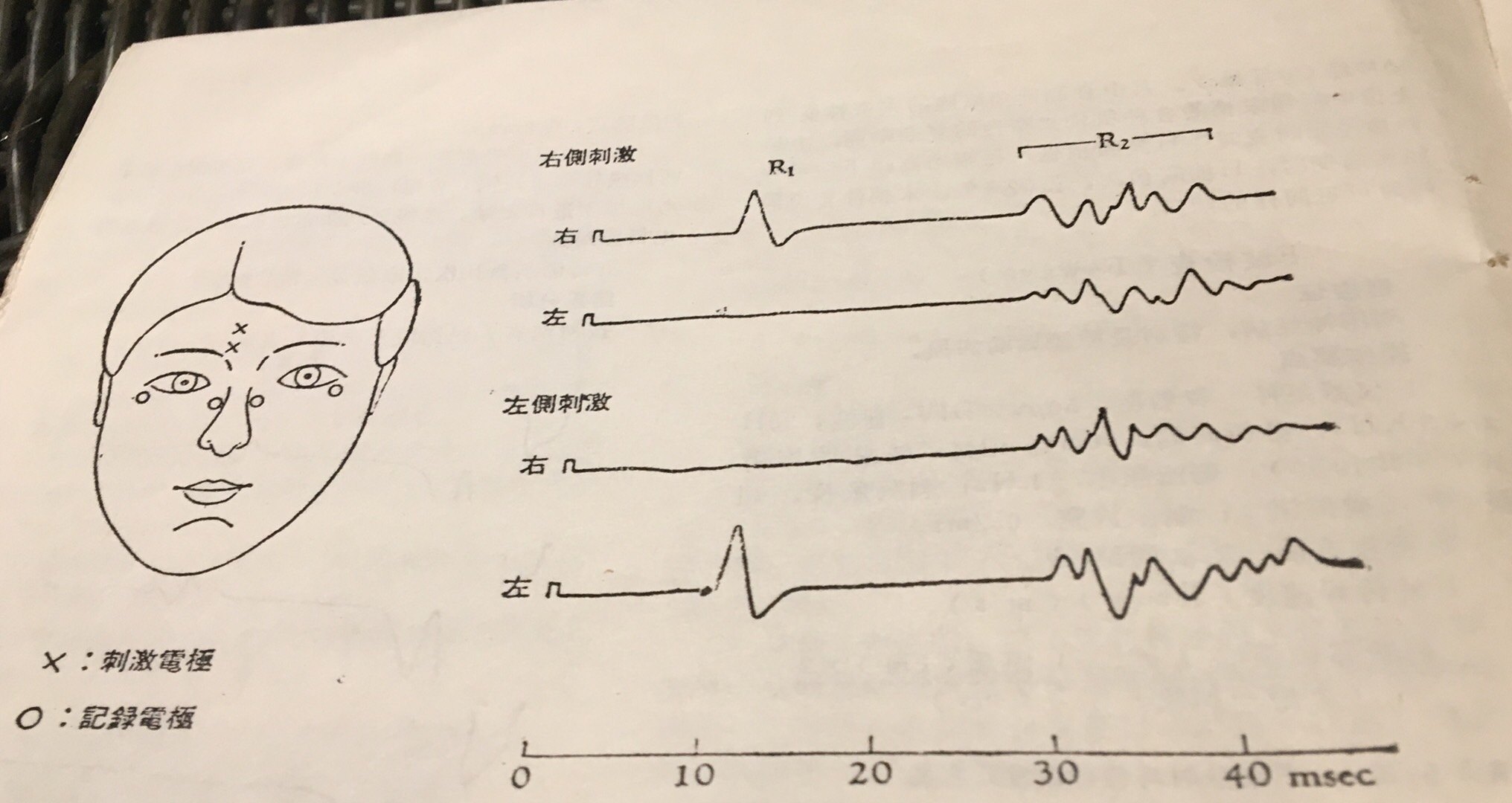 瞬目反射(眨眼反射)的检查与应用 - 好大夫在线