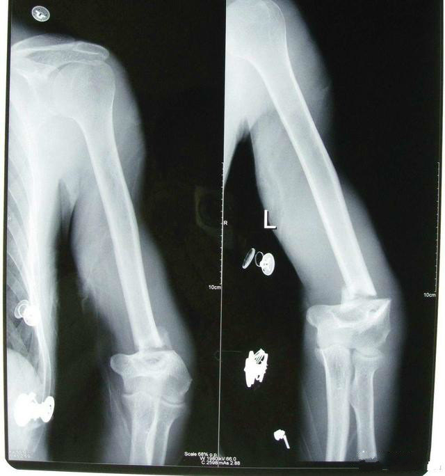 如何区别肘关节脱位和肱骨下端骨折 好大夫在线 如何区别肘关节脱位和肱骨下端骨折 好大夫在线