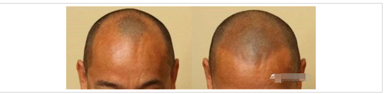 没有毛囊不能植发的 终极秃 该怎么办