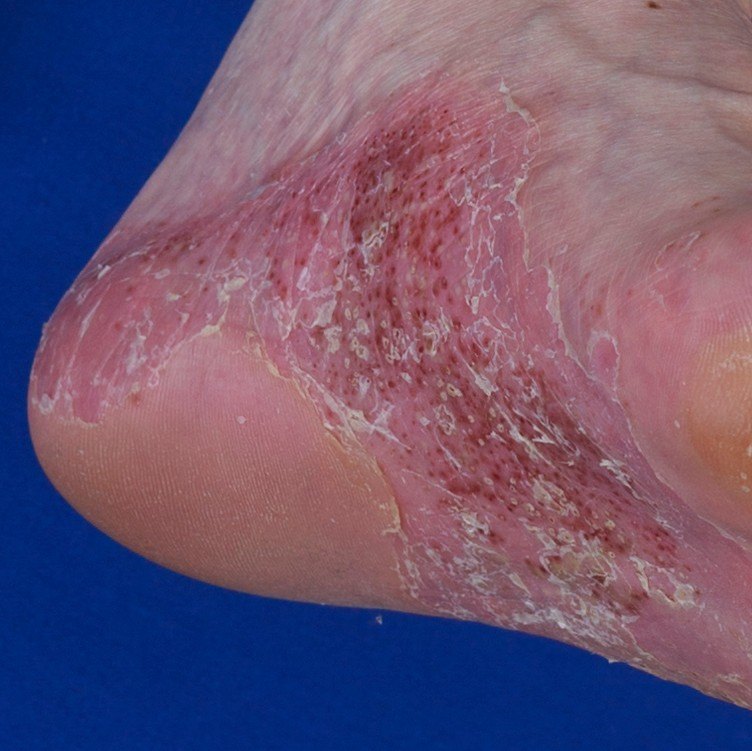 掌跖脓疱病和单发于掌跖的脓疱型银屑病鉴别诊