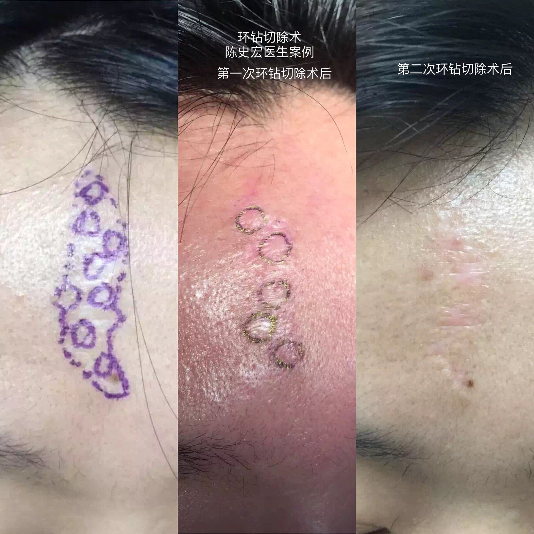 后即刻效果该图片可能引起不适继续查看疤痕切除 精细缝合该图片可能