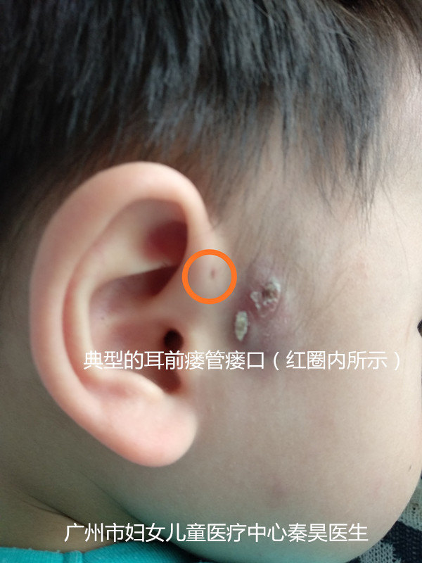 耳前瘘管反复感染怎么办?