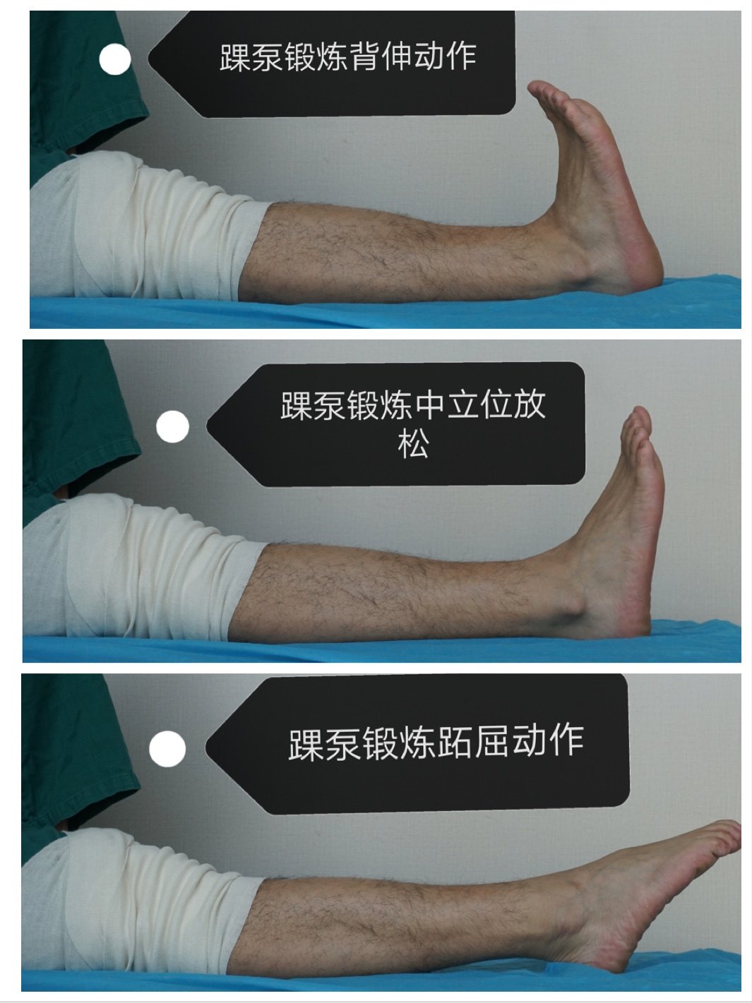 半月板修整或切除术后康复计划