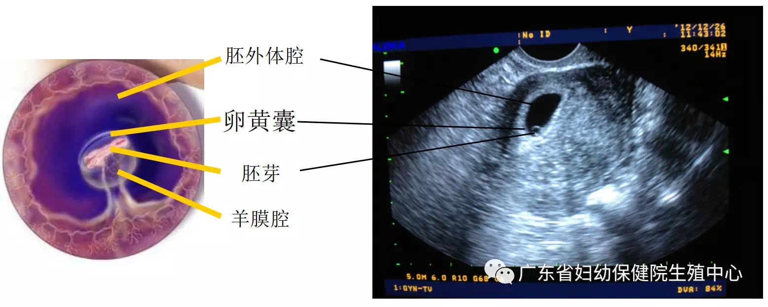 妊娠天數及週數計算如一個孕囊內有兩個卵黃囊及兩個胚芽,則為單卵