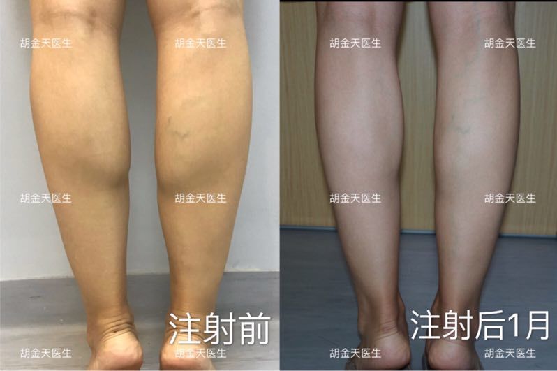 肉毒素瘦小腿15