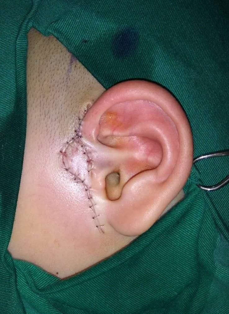 耳前瘘管术后痊愈图片图片