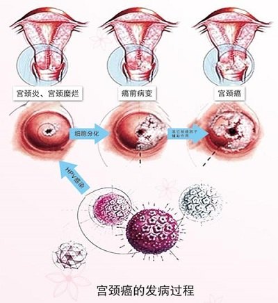 宫颈癌的临床表现