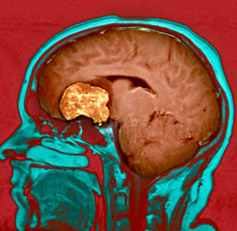 带你认识脑胶质瘤(1)