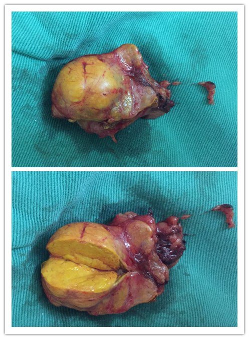 精准解剖式腹腔镜肾上腺切除术具有以下优点:术中解剖层次清楚,视野