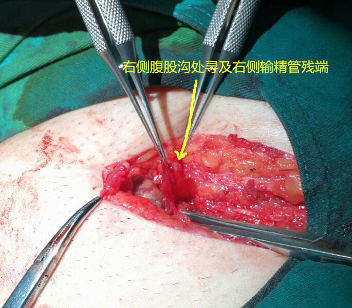而另一个断端在内环口,相距10cm,考虑左侧输精管疝气手术损伤较为严重