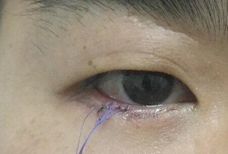 眼睑色素痣,眼睑肿物术前术后对比图 - 好大夫在线