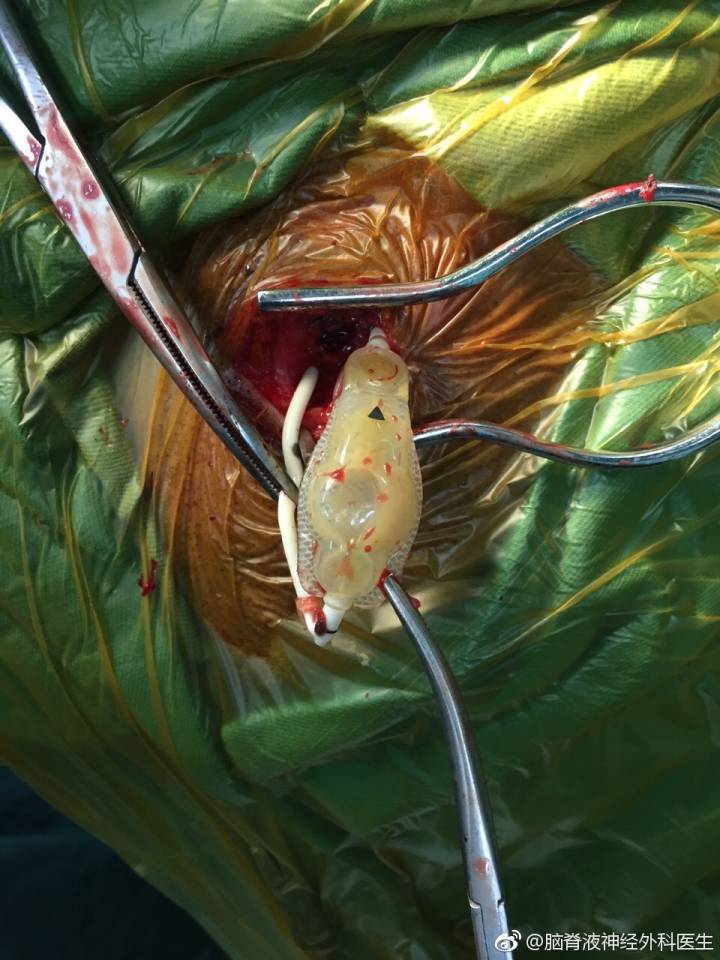 脑积水分流感染特殊病例 - 好大夫在线