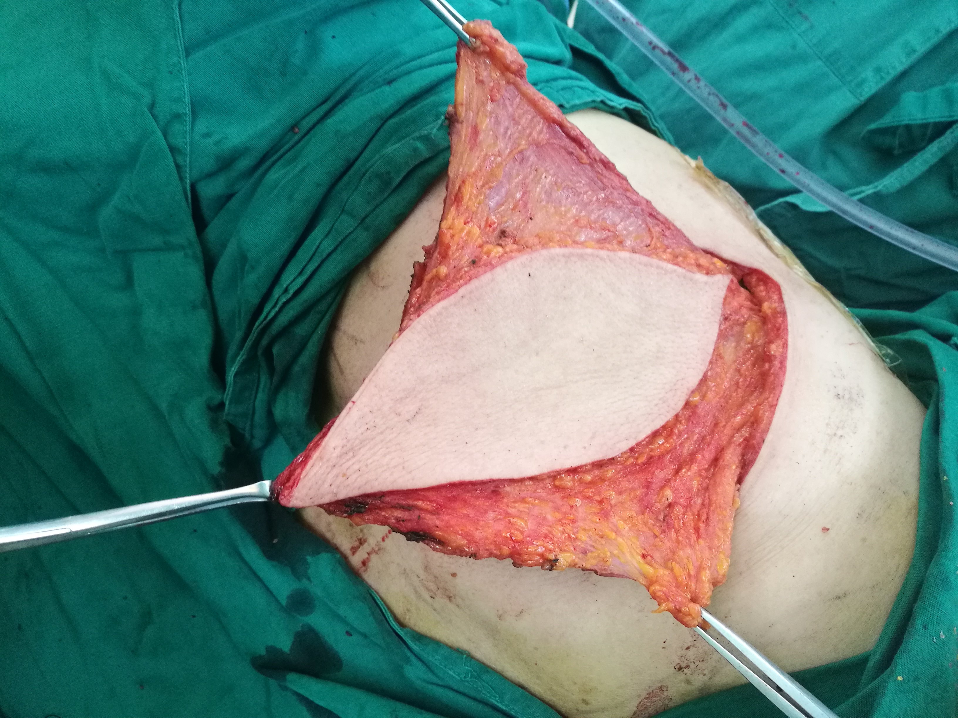 乳房全切手术乳腺癌图片