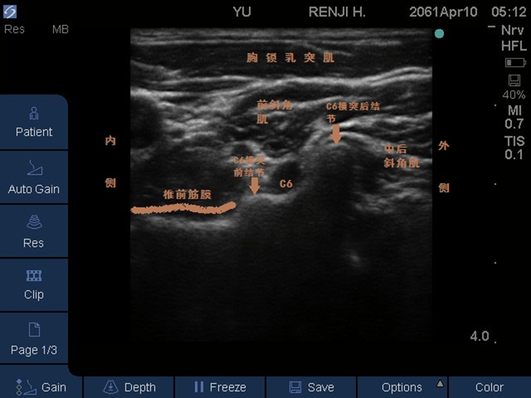 链球菌感染后状态一个月低热正常吗_链球菌感染低烧持续多久才能好_链球菌感染后低热综合征