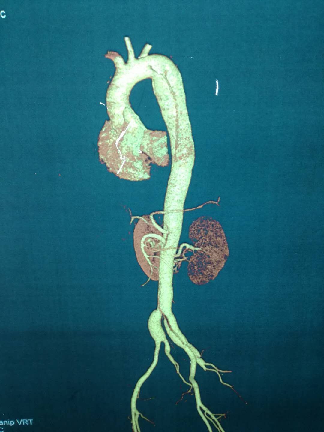 stanford b型主动脉夹层的腔内修复术 - 好大夫在线
