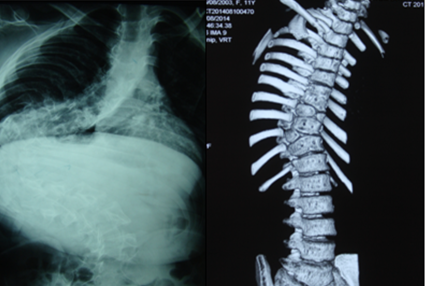 脊柱侧弯相关知识十问十答