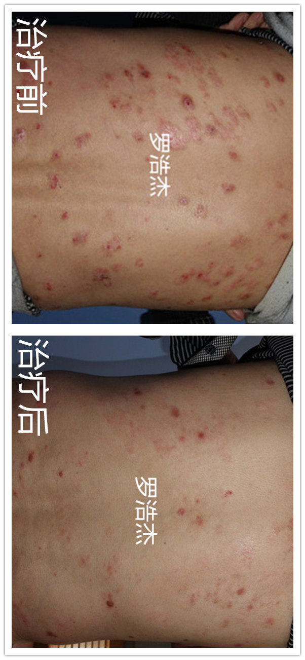 给予口服中药调理治疗,在患者出院当天,我去看患者,全身皮疹明显消退