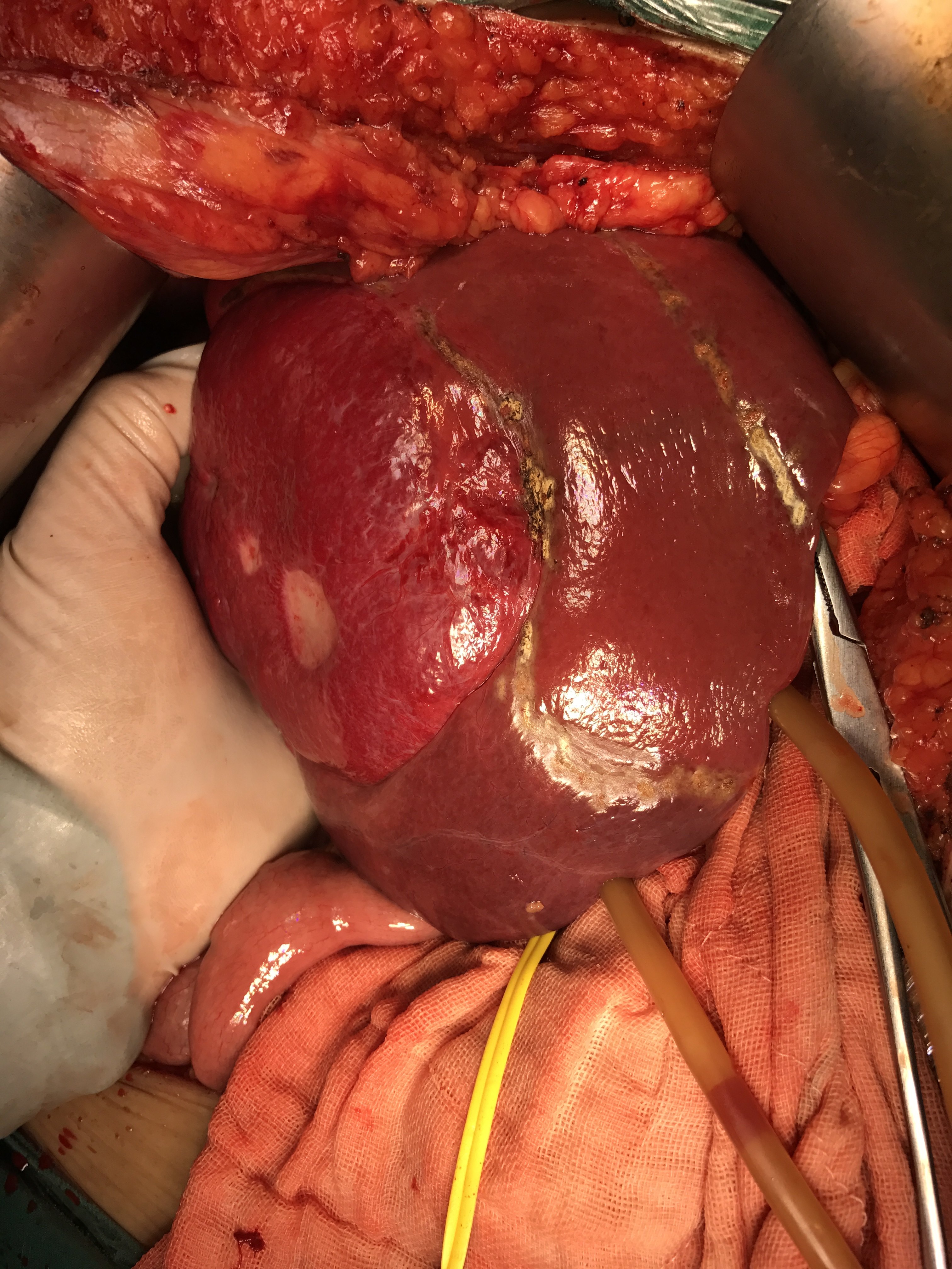 肝脏血管瘤手术治疗图片分享 
