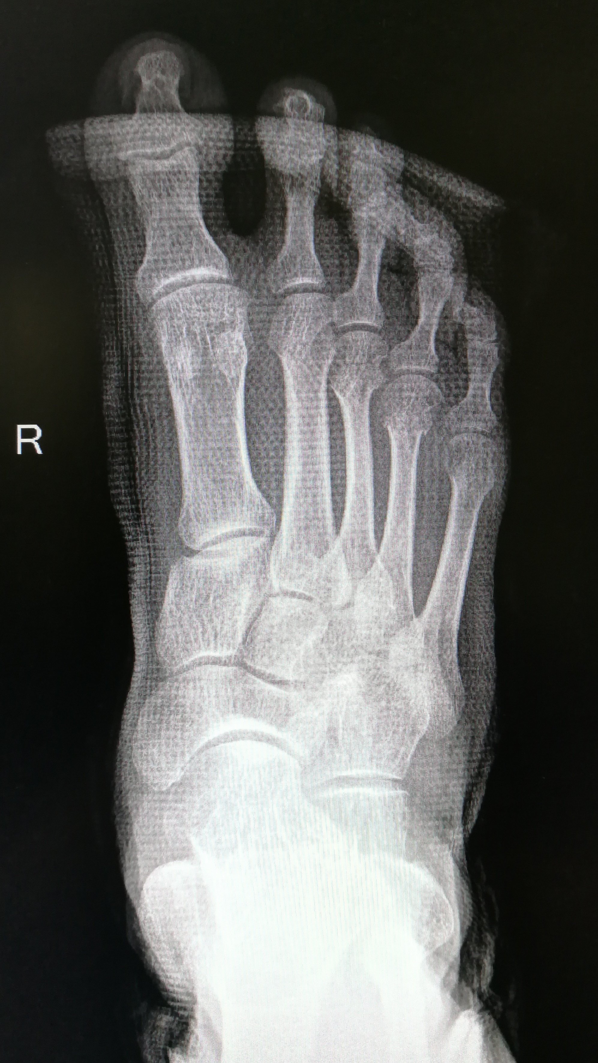 右足第一楔骨骨折图片图片