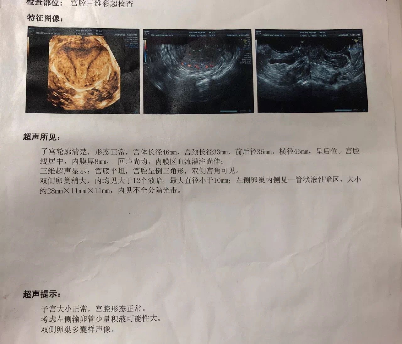 为什么试管前需要处理输卵管积水?-2