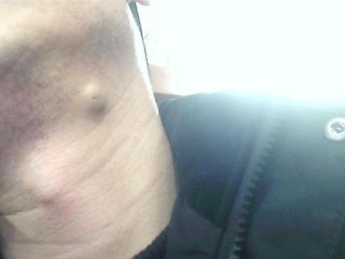 什么是粉瘤 怎么处理 怎么预防 皮脂腺囊肿 疾病介绍 预防 什么是粉瘤 怎么处理 怎么预防 皮脂腺囊肿 疾病介绍 预防