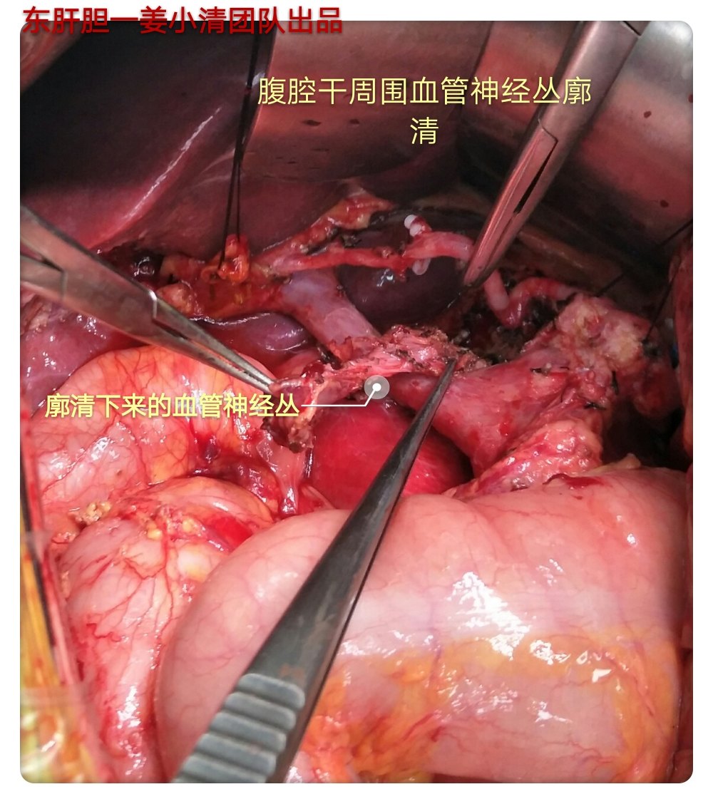 一臺pd胰十二指腸切除術的兩個手術細節