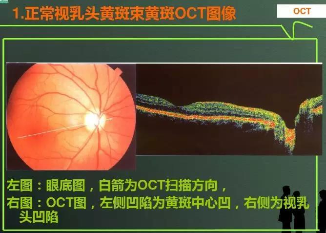 眼科oct检查图解红绿色图片