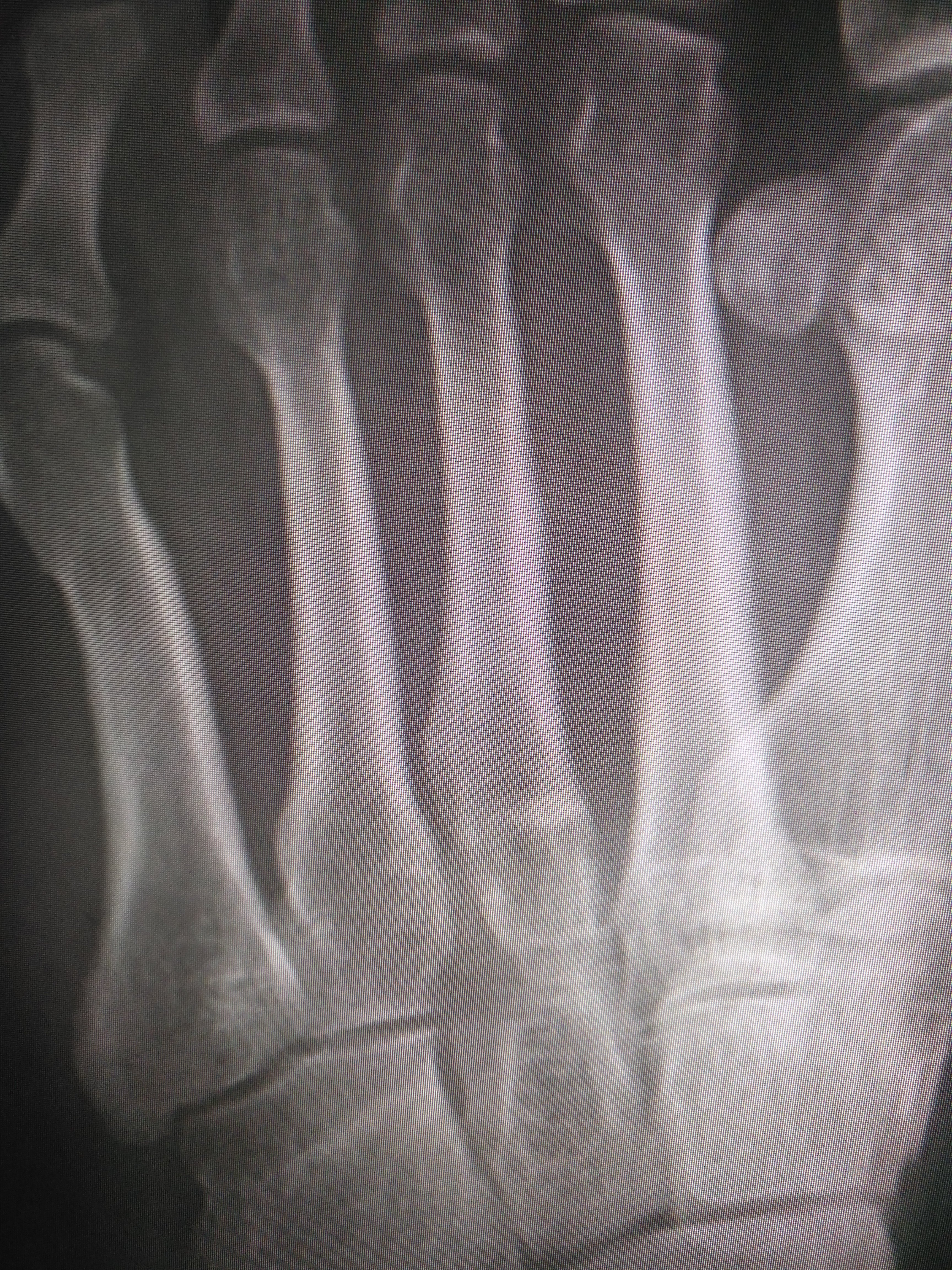 伤筋动骨100天,自身的亲身体验