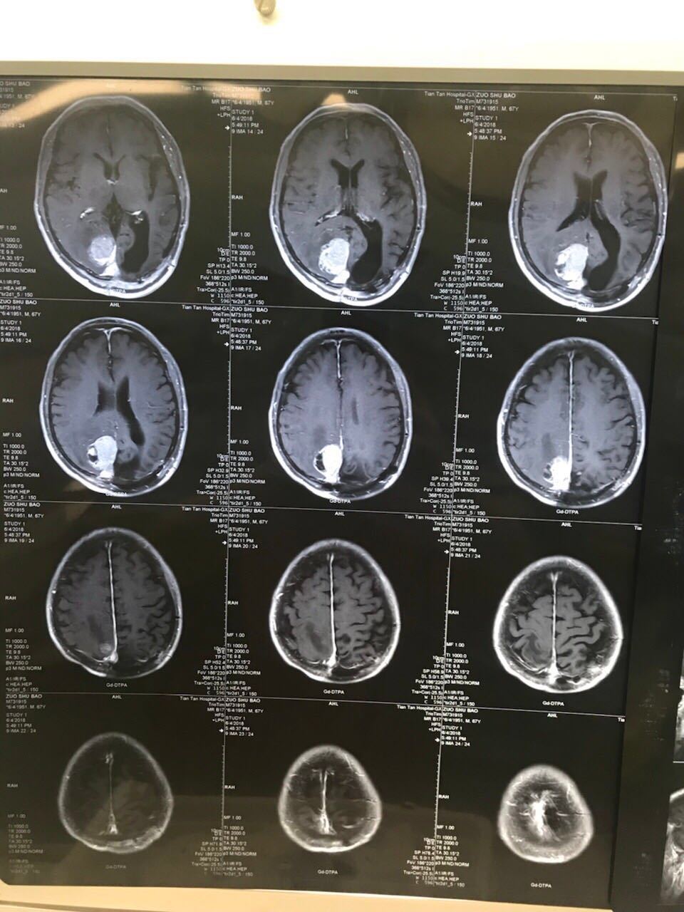 顶枕部复发脑膜瘤