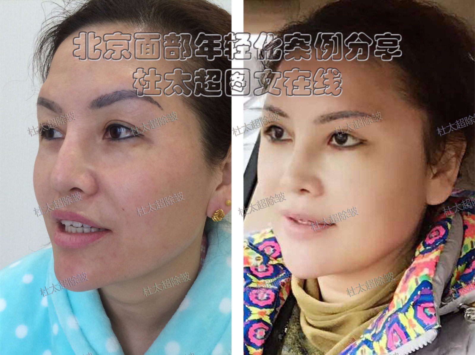 拉皮\/除皱\/提升整形必修课:可调式微升美,15年