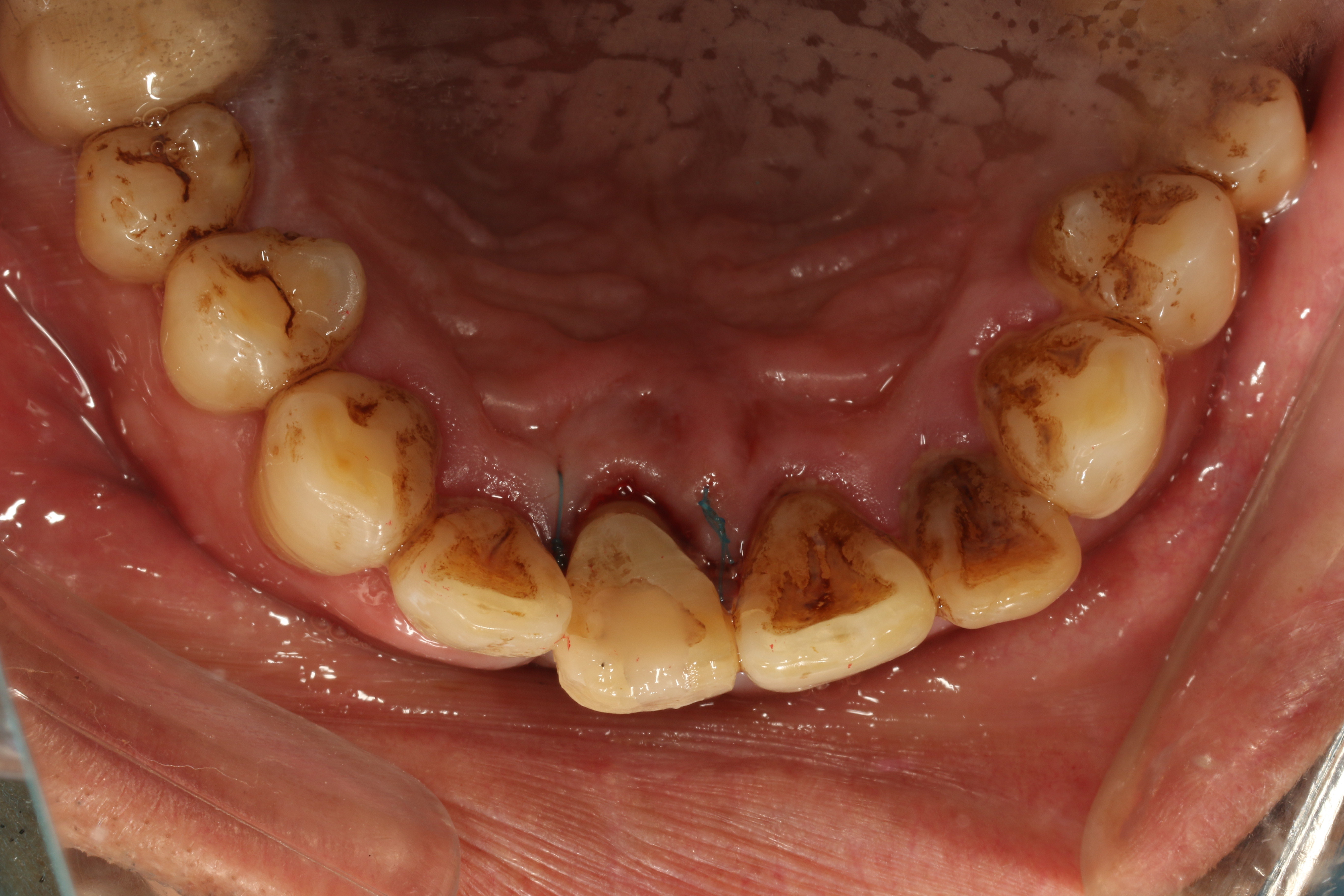 牙槽裂术前后图片图片